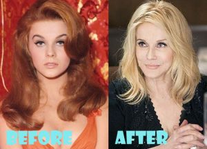 Ann Margret Plastic Surgery