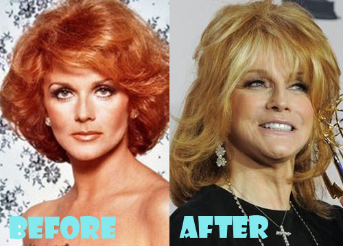Ann Margret Plastic Surgery Before and After Pictures