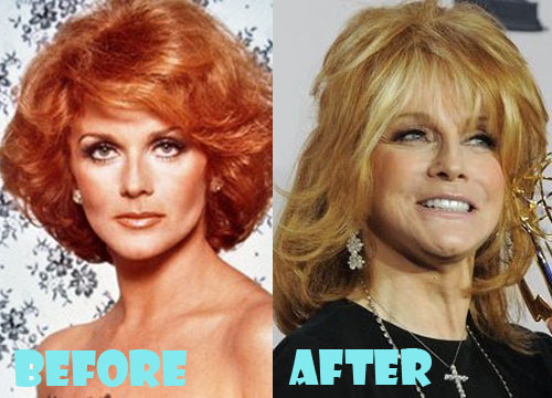 Ann Margret Plastic Surgery Botox, Facelift