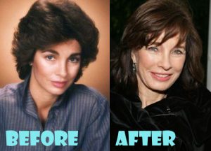 Anne Archer Plastic Surgery