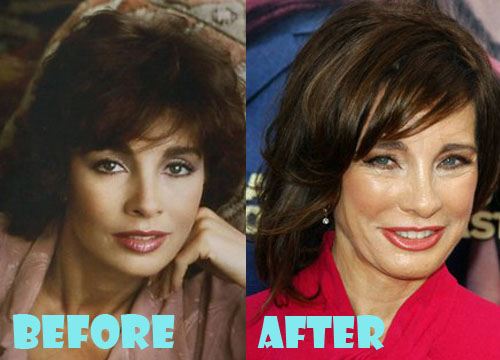 Anne Archer Plastic Surgery Botox, Facelift