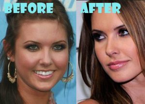 Audrina Patridge Plastic Surgery Nose Job