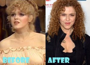 Bernadette Peters Plastic Surgery