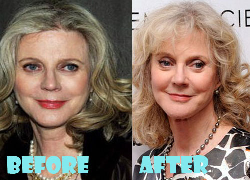 Blythe Danner Plastic Surgery Before And After Picture