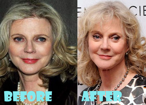 Blythe Danner Plastic Surgery