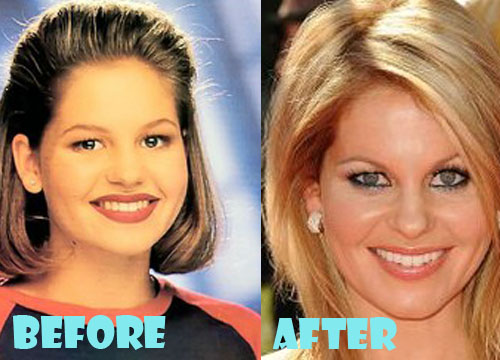 Candace Cameron Plastic Surgery Before and After Nose Job