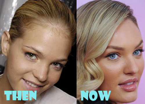 Candice Swanepoel Plastic Surgery Before and After Picture