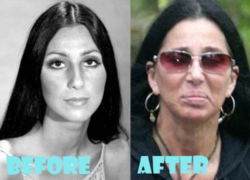 Cher Plastic Surgery Before and After Pictures