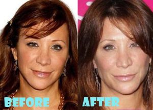 Cheri Oteri Plastic Surgery Botox, Facelift