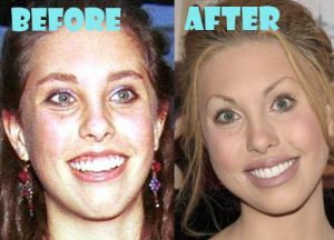 Chloe Lattanzi Plastic Surgery