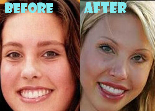 Chloe Lattanzi Plastic Surgery Before and After Pictures