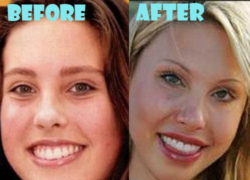 Chloe Lattanzi Plastic Surgery Lip Implant