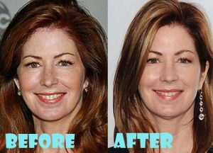 Dana Delany Plastic Surgery