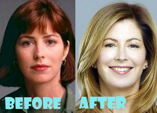Dana Delany Plastic Surgery Before and After Pictures