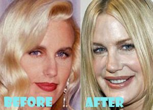 Daryl Hannah Plastic Surgery Gone Wrong