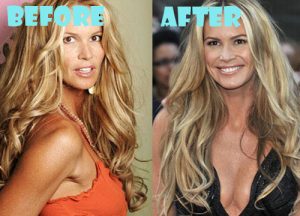 Elle Macpherson Plastic Surgery Breast Implant