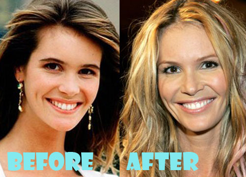 Elle Macpherson Plastic Surgery Before and After Picture