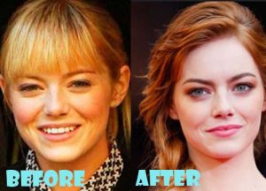 Emma Stone Plastic Surgery