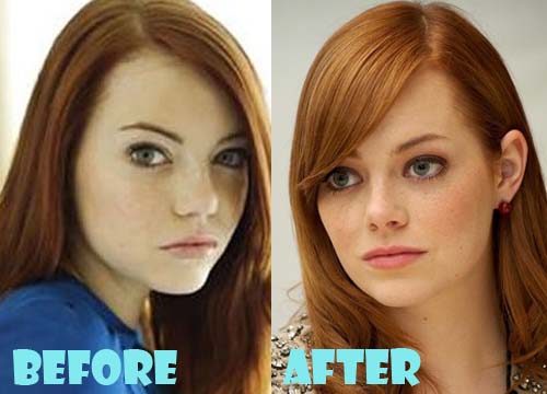 Emma Stone Plastic Surgery Nose Job