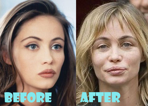 Emmanuelle Beart Plastic Surgery Before and After Pictures