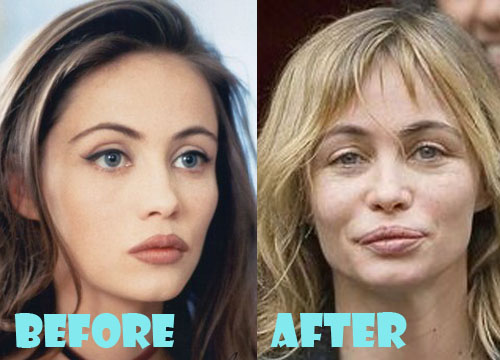 Emmanuelle Beart Bad Plastic Surgery