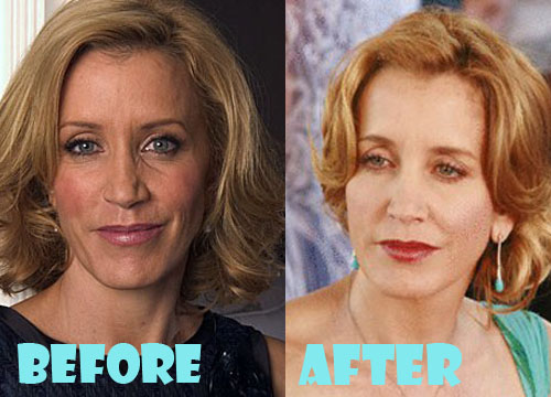 Felicity Huffman Facelift Surgery