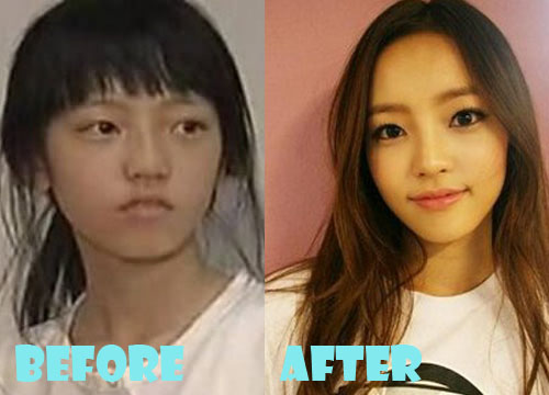 Goo Hara Plastic Surgery Before and After Picture