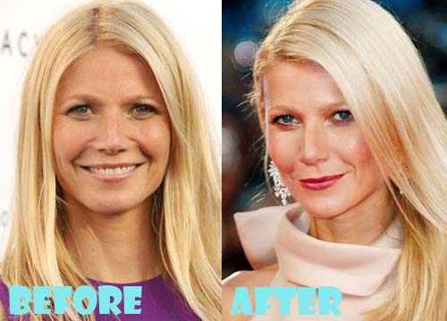 Gwyneth Paltrow Plastic Surgery Before and After Facelift