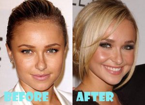Hayden Panettiere Plastic Surgery Nose Job