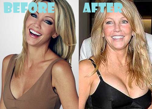 Heather Locklear Plastic Surgery Breast Implant