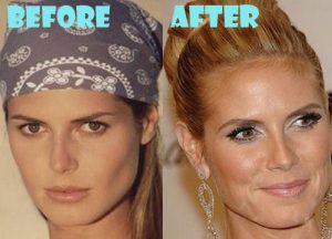 Heidi Klum Plastic Surgery