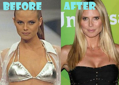 Heidi Klum Plastic Surgery Boob Job