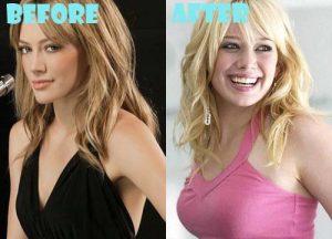 Hilary Duff Plastic Surgery Breast Implant