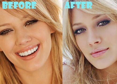 Hilary Duff Plastic Surgery Before and After Breast Implant, Nose Job