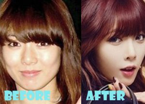 Hyuna Plastic Surgery