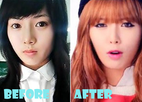 Hyuna Plastic Surgery Before and After Picture