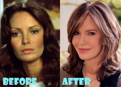 Jaclyn Smith Plastic Surgery Botox, Facelift