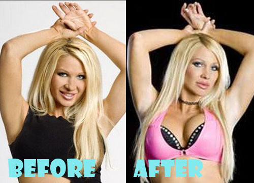 Jillian Hall Plastic Surgery Before and After Pictures