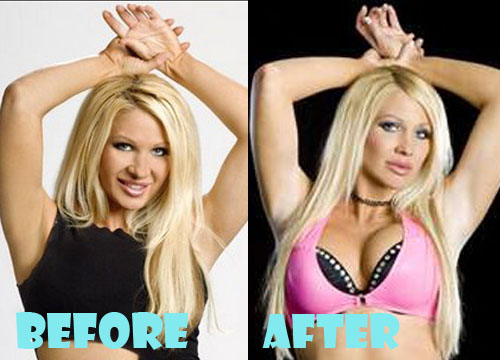 Jillian Hall Plastic Surgery Breast Implant