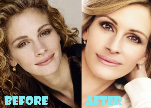 Julia Roberts Plastic Surgery