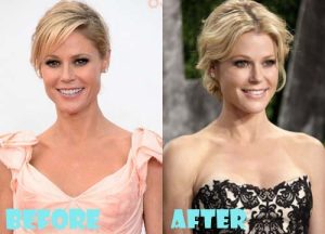 Julie Bowen Plastic Surgery