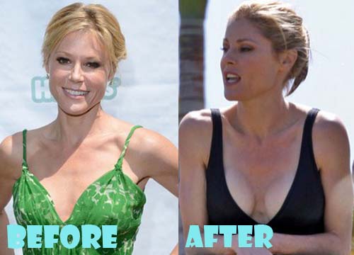 Julie Bowen Plastic Surgery Before and After Breast Implant