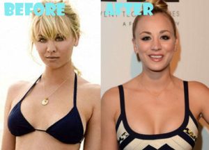 Kaley Cuoco Plastic Surgery