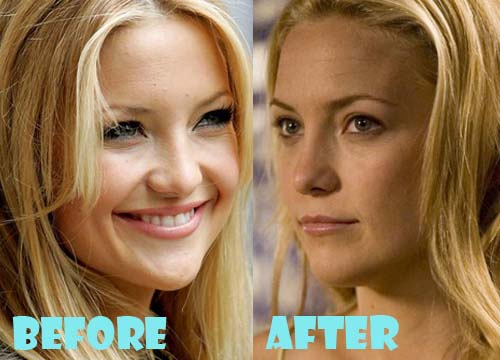 Kate Hudson Plastic Surgery Nose Job.