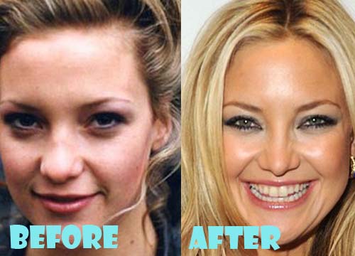 Kate Hudson Plastic Surgery Before And After Nose Job