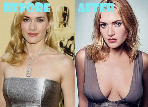 Kate Winslet Plastic Surgery Before and After Photos