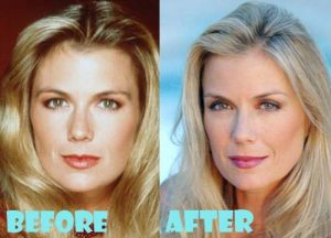 Katherine Kelly Lang Plastic Surgery