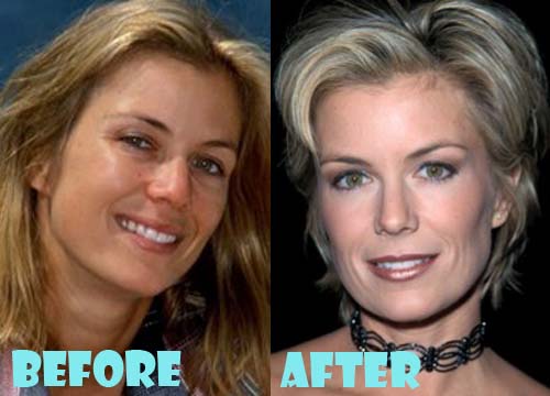 Katherine Kelly Lang Plastic Surgery Before and After Photos