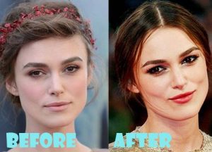 Keira Knightley Plastic Surgery