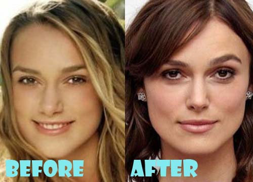 Keira Knightley Plastic Surgery Nose Job